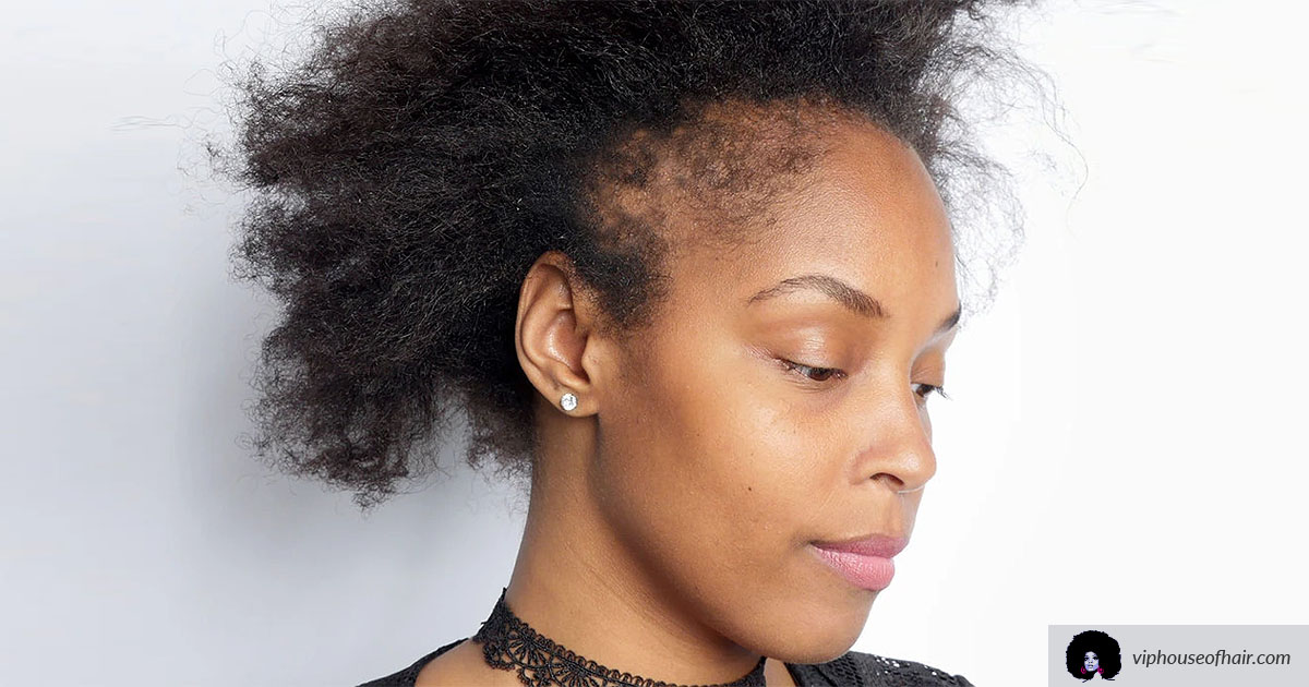 What You Need To Know About Alopecia